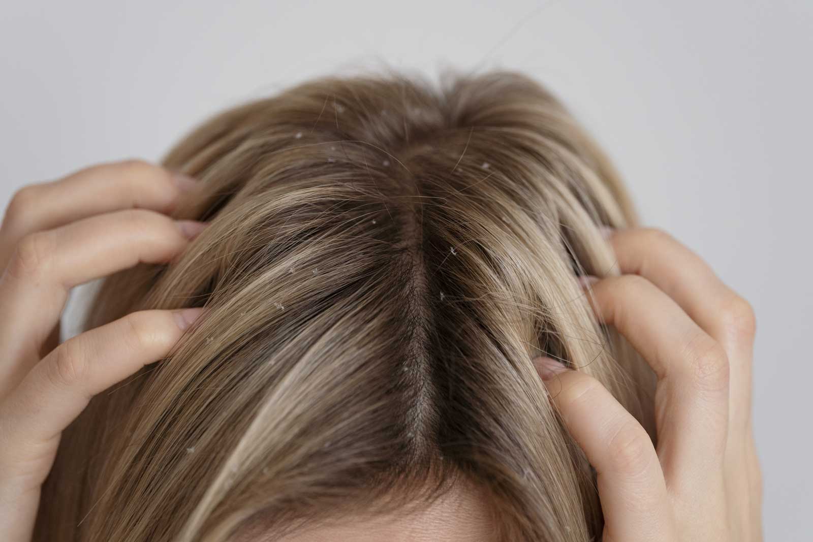 woman-with-dandruff-issues-close-up
